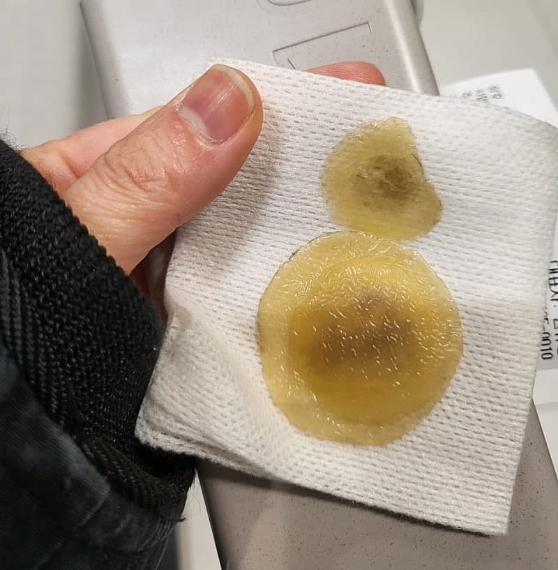 동대문피부과는 흑자 맛집이 없네요… 결국 서대문구까지 갔어요ㅎ 1