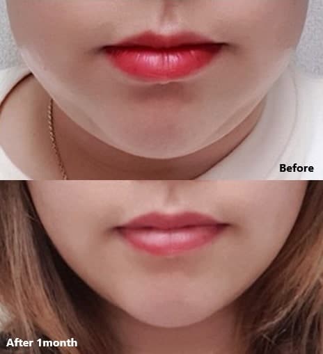 울쎄라 슈링크 가격 대비 리프팅 효과 차이 크나요? 1