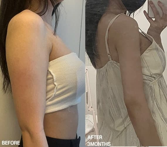 팔뚝지방흡입 가격 후기 수술비용 70만원? 1