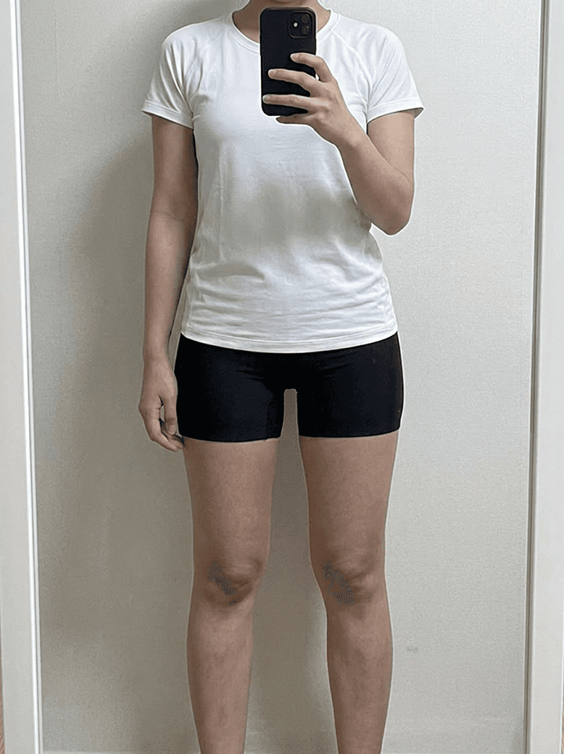 대구 달서구 다이어트 병원에서 허벅지 안쪽 정리했습니다! 5