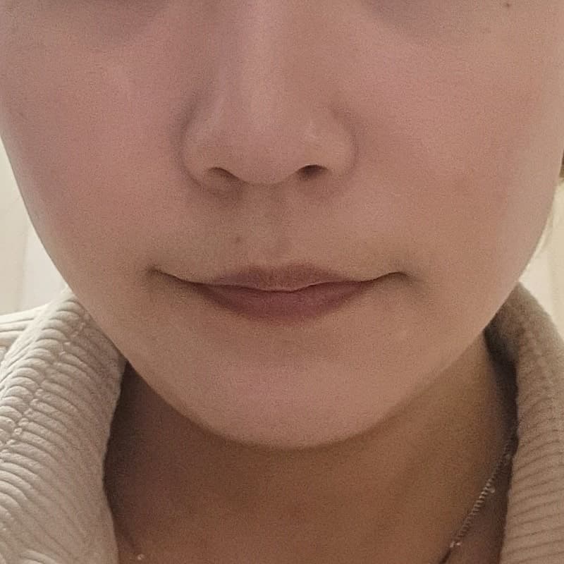 탄력리프팅으로 신논현역써마지 효과 괜찮겠죠? 3