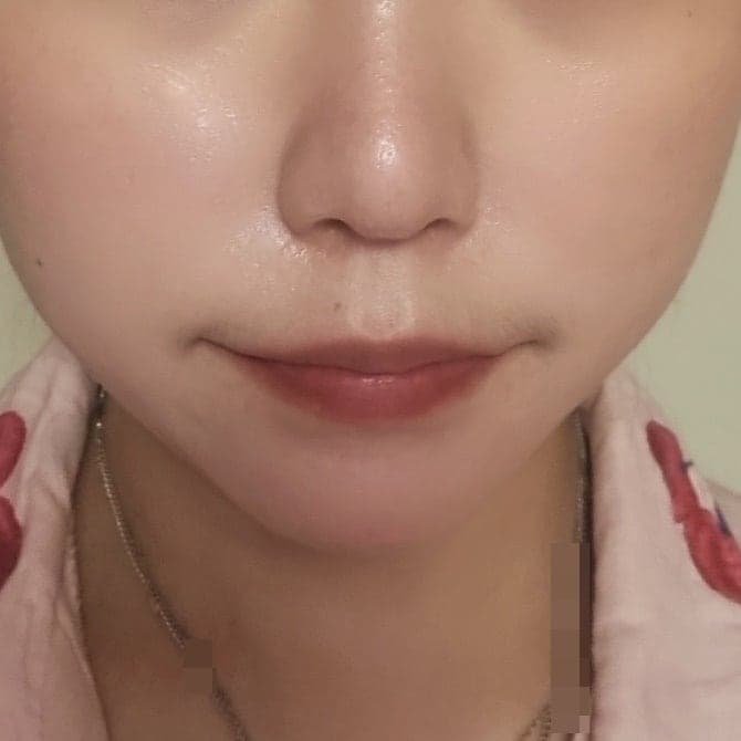 탄력리프팅으로 신논현역써마지 효과 괜찮겠죠? 4