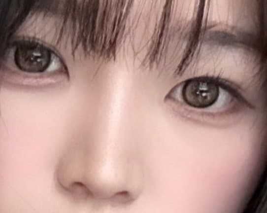 눈가주름보톡스 효과 있나요? 1