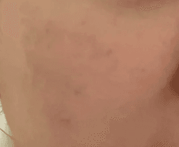 청주기미제거 어디가 잘해요? 1
