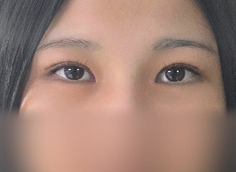 자련유착 쌍수하나로 자신감 뿜뿜이예요/ㅇㅂㅈ 장욱원장님 1