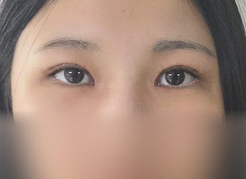 자련유착 쌍수하나로 자신감 뿜뿜이예요/ㅇㅂㅈ 장욱원장님 2