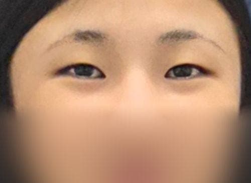 자련유착 쌍수하나로 자신감 뿜뿜이예요/ㅇㅂㅈ 장욱원장님 3