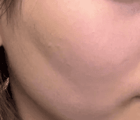 비산동피부과 어디로 다니세요? 리프팅 받으려고요 1
