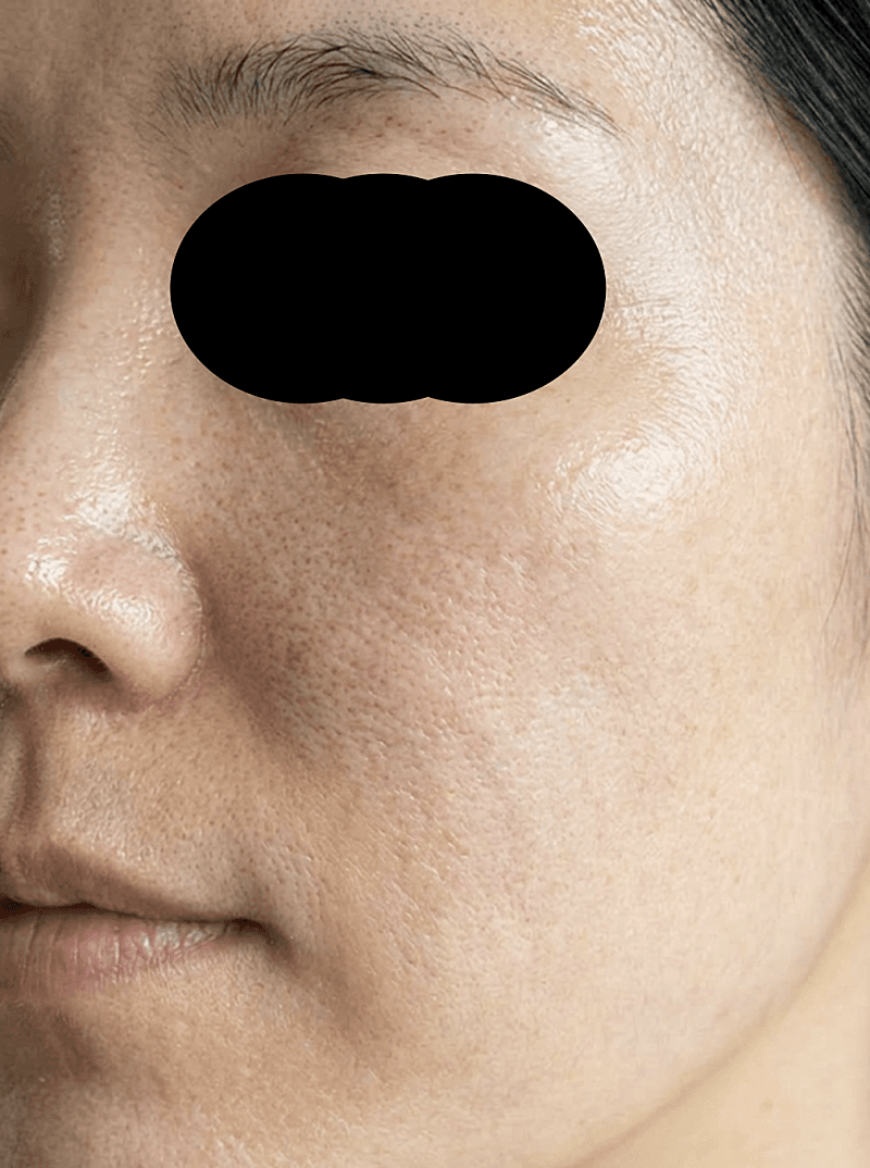 성수동 피부과 여드름 때문에 다녀온 후기! 5