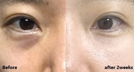 눈밑지방재배치수술비용 49마넌? 1