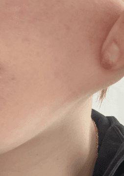 은계지구피부과 리프팅 잘하는 곳 추천좀요 1
