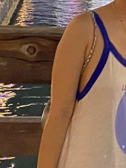 대구 h클리닉 지방분해주사 찐 후기 5