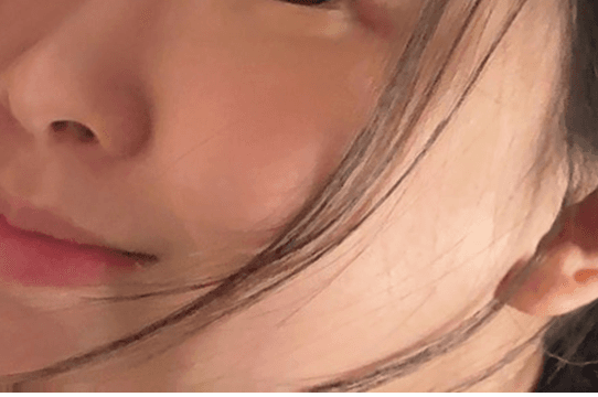 이중턱,볼 처짐 여러 시술 해보다가 울쎄라피프라임 12
