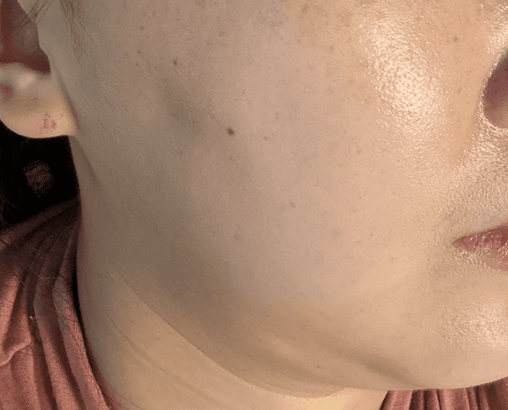 이중턱,볼 처짐 여러 시술 해보다가 울쎄라피프라임 3
