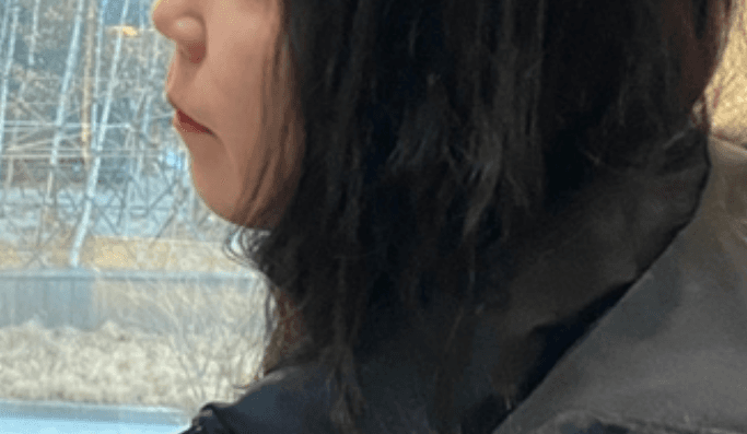 이중턱,볼 처짐 여러 시술 해보다가 울쎄라피프라임 5