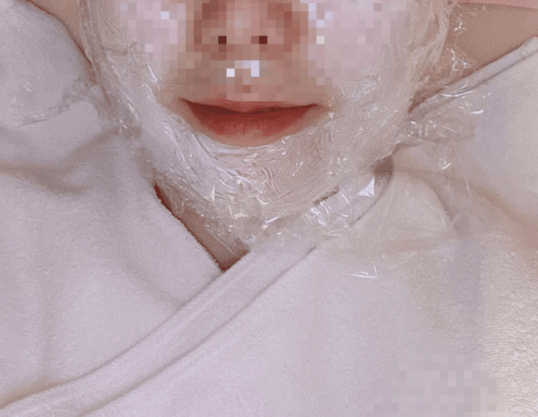 이중턱,볼 처짐 여러 시술 해보다가 울쎄라피프라임 6