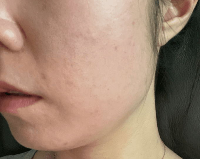 이중턱,볼 처짐 여러 시술 해보다가 울쎄라피프라임 9