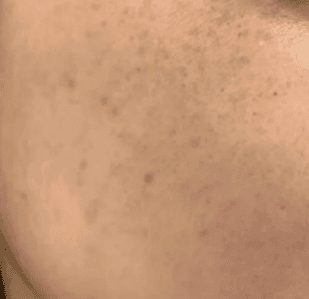안산고잔동피부과 피코토닝 잘하는 곳 있나요? 1