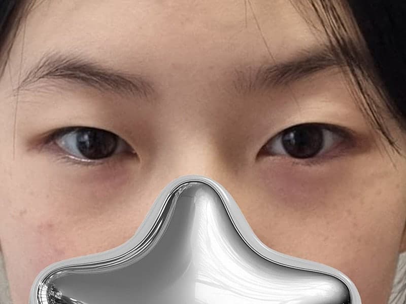 눈매교정수술전후 짝눈 교정 완료 1