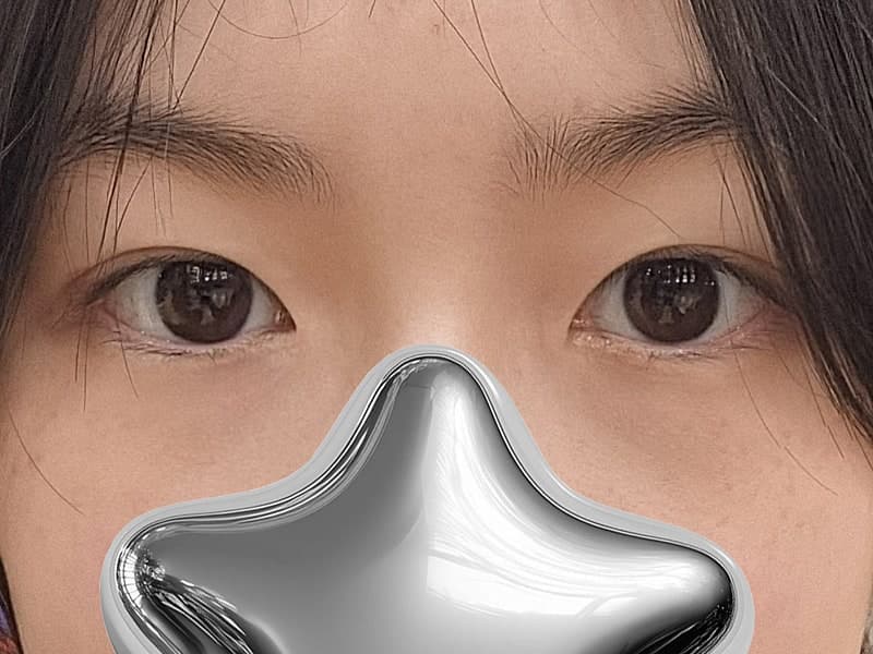눈매교정수술전후 짝눈 교정 완료 2