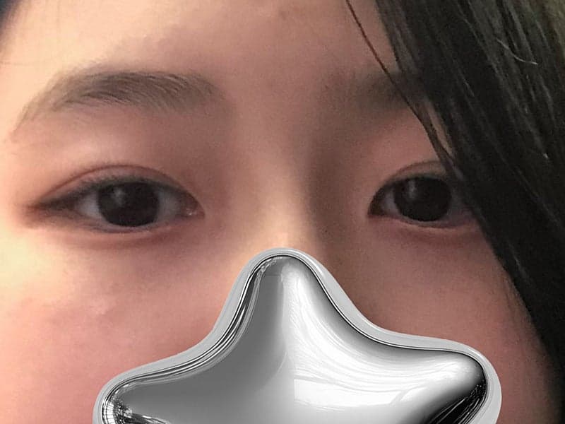눈매교정수술전후 짝눈 교정 완료 3