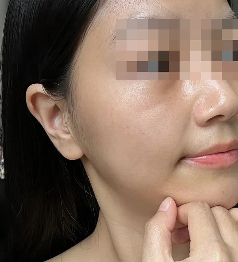 광주 피부탄력 고민 끝낸 리프팅 후기 1