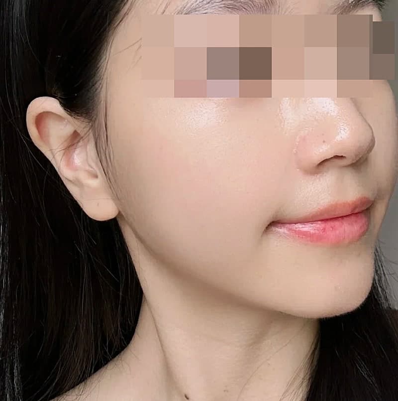 광주 피부탄력 고민 끝낸 리프팅 후기 2