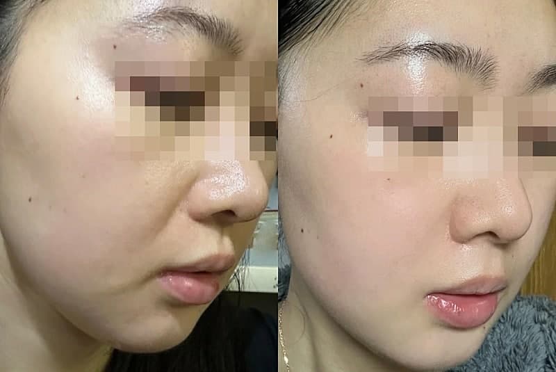 쥬베룩볼륨 팔자주름 전후 2