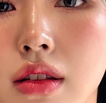 쥬베룩 스킨부스터 부작용+결절 줄이는방법 1