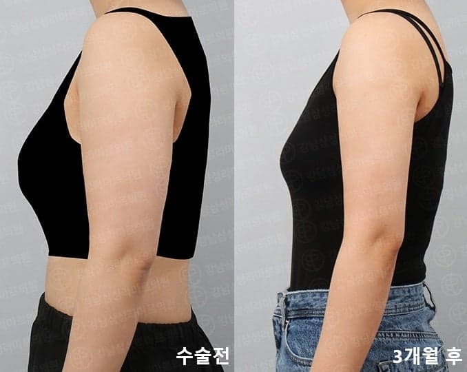 팔지방흡입가격 15마넌부터 적당한듯 1