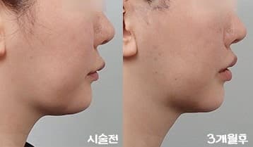 강남역 울쎄라 잘하는곳 추천! 1