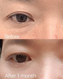 20대 눈밑주름제거수술 괜찮을까? 1