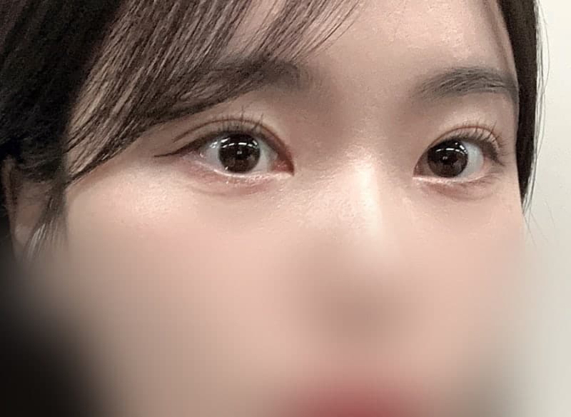 인아웃 맛집 찾으시면 오브제요ㅠㅠ 박시현 원장님 쌍꺼풀재수술 후기!! 5