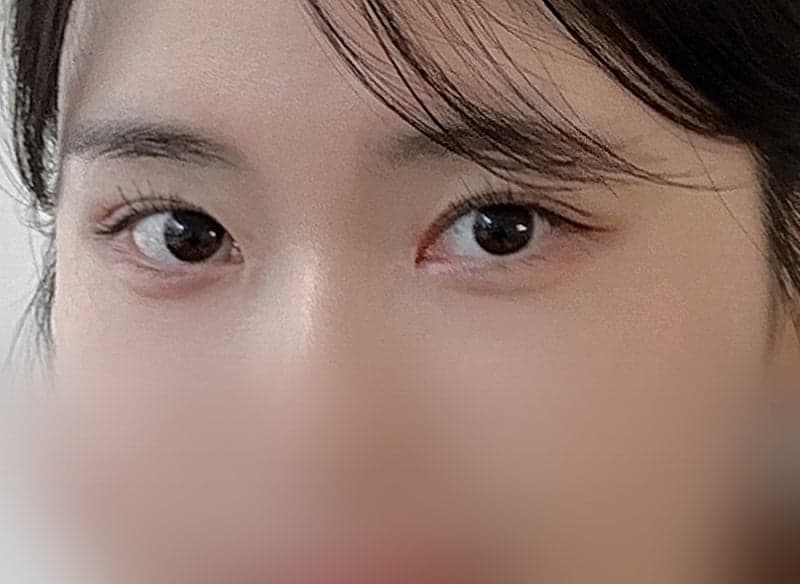 인아웃 맛집 찾으시면 오브제요ㅠㅠ 박시현 원장님 쌍꺼풀재수술 후기!! 6