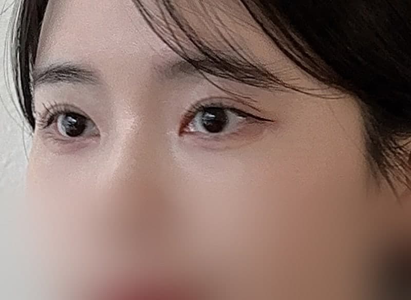 인아웃 맛집 찾으시면 오브제요ㅠㅠ 박시현 원장님 쌍꺼풀재수술 후기!! 1