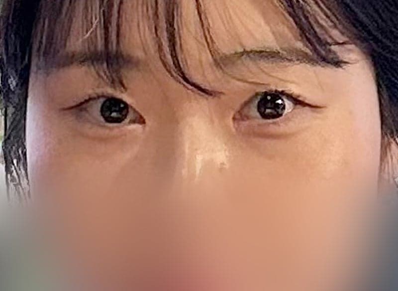 인아웃 맛집 찾으시면 오브제요ㅠㅠ 박시현 원장님 쌍꺼풀재수술 후기!! 2