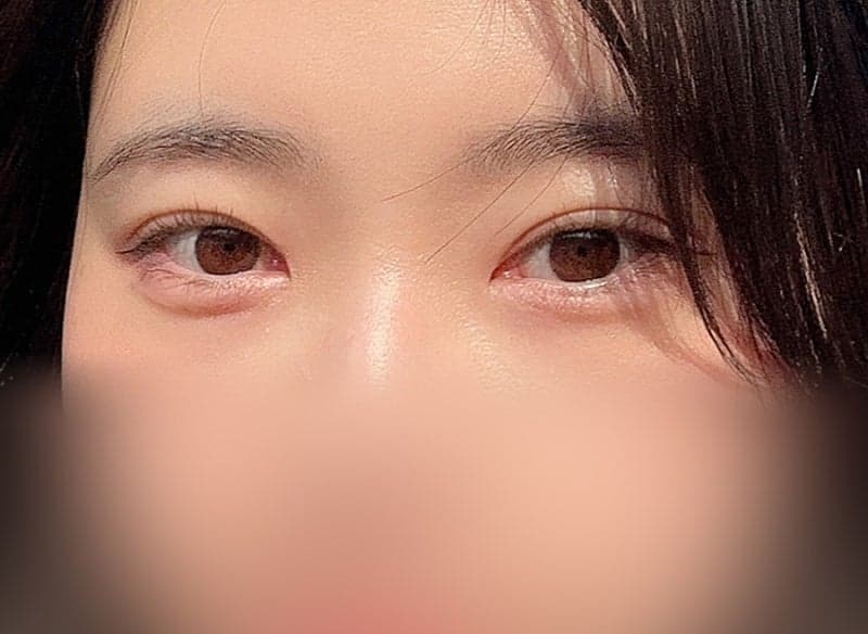 인아웃 맛집 찾으시면 오브제요ㅠㅠ 박시현 원장님 쌍꺼풀재수술 후기!! 3
