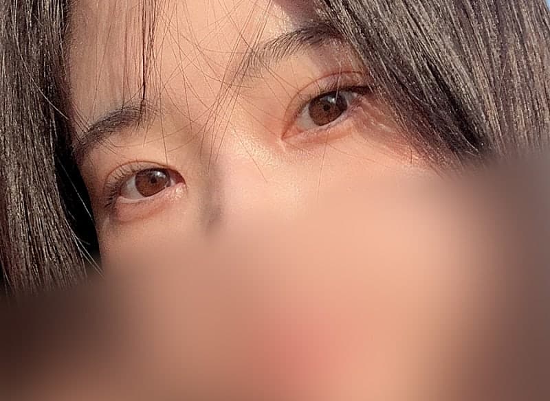 인아웃 맛집 찾으시면 오브제요ㅠㅠ 박시현 원장님 쌍꺼풀재수술 후기!! 4
