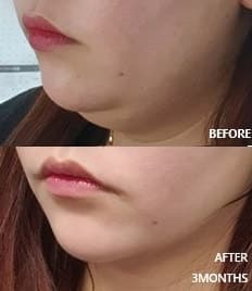 턱살지방흡입가격 볼살지방흡입까지 69마넌 1