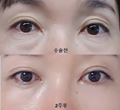 눈밑지방재배치가격 눈밑꺼짐시술 보다나음 1