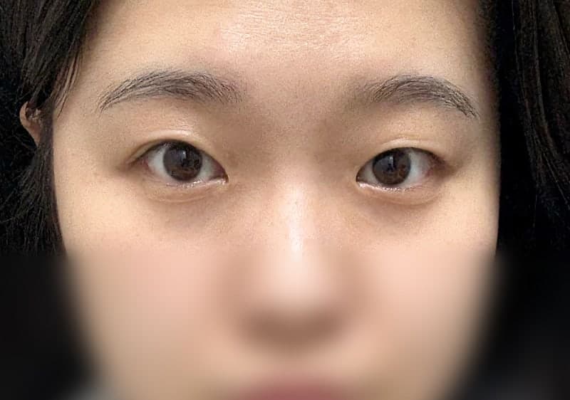 절개 쌍수 풀려서 ㅇㅂㅈ 박시현원장님한테 비절개로 재수술 받았어요! 1