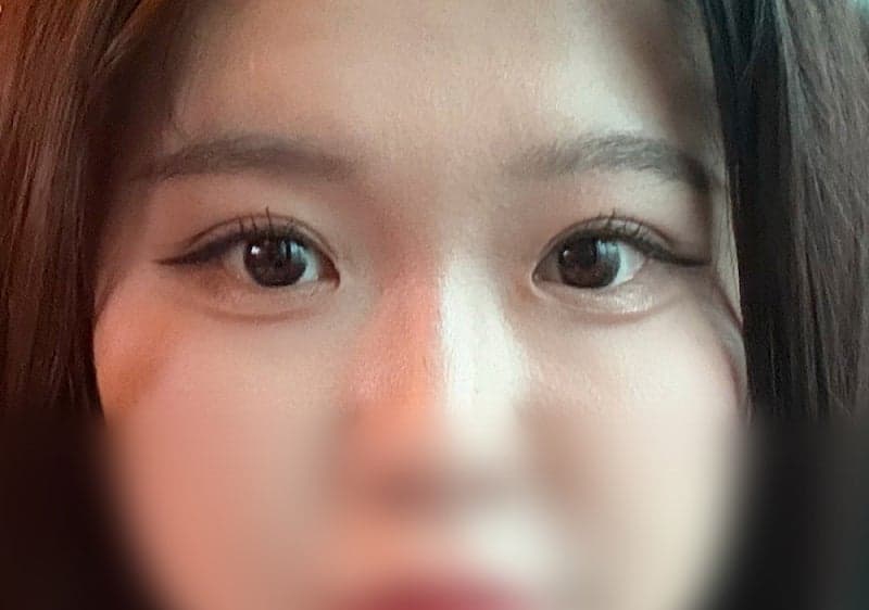 절개 쌍수 풀려서 ㅇㅂㅈ 박시현원장님한테 비절개로 재수술 받았어요! 2