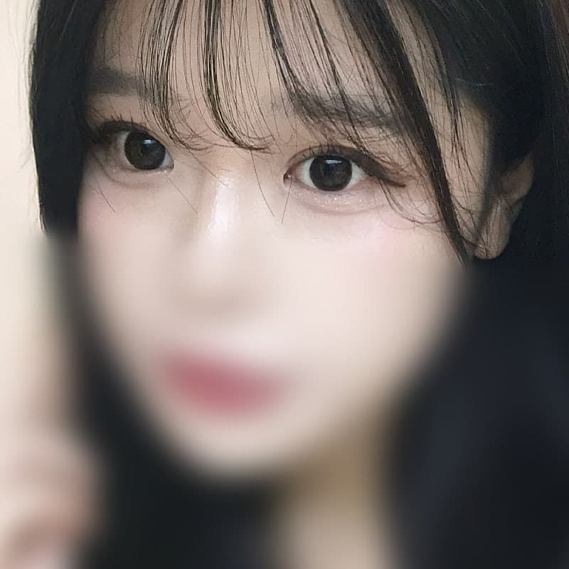 절개 쌍수 풀려서 ㅇㅂㅈ 박시현원장님한테 비절개로 재수술 받았어요! 3