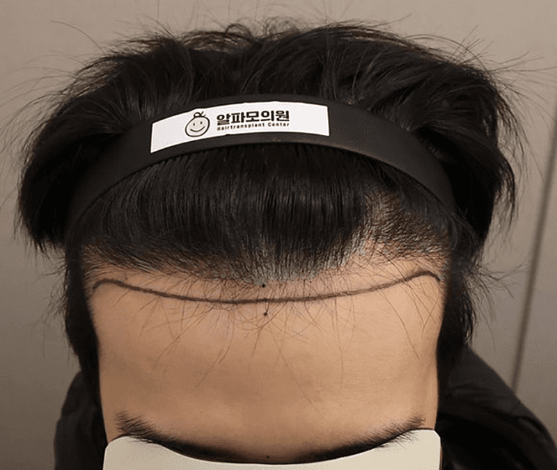 강남탈모치료병원 상담만 받으러 갔다가 당일에 수술까지 결정한 이유 1