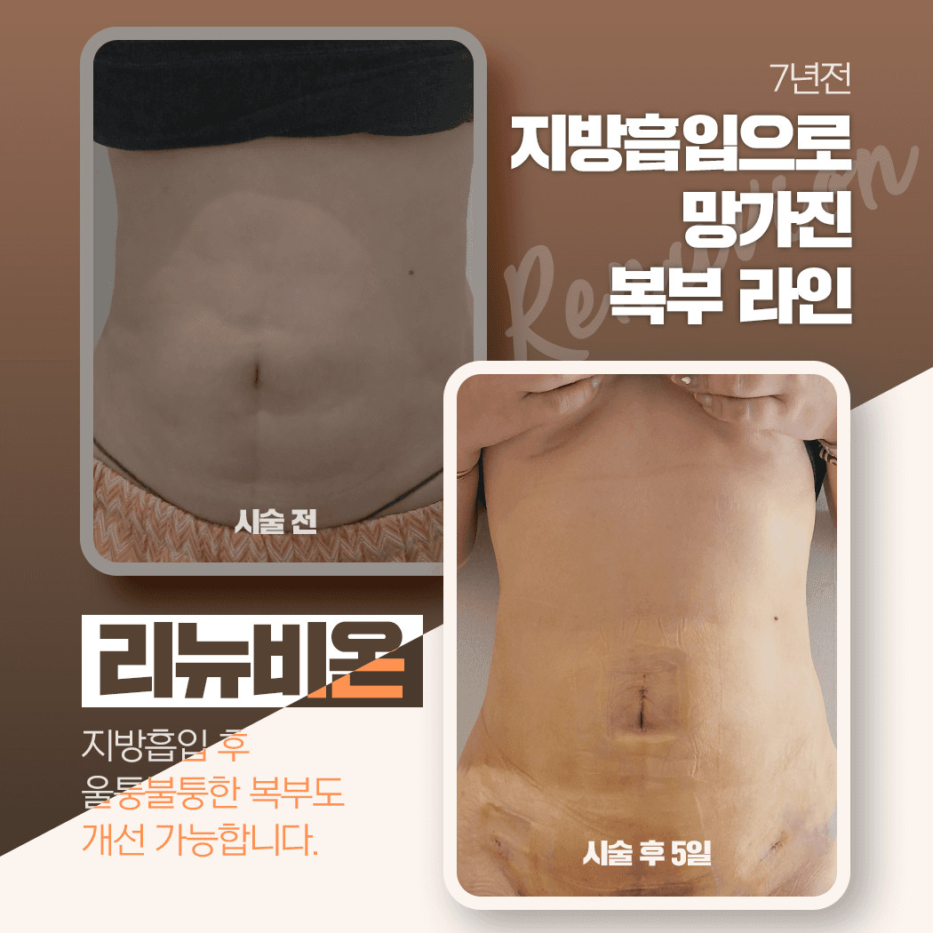 리뉴비온