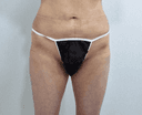 골반필러용량 골반필러가격 궁금하신분??