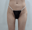 골반필러 진심 강추해요 대박ㅜㅜ (골반필러+힙딥필러 후기)