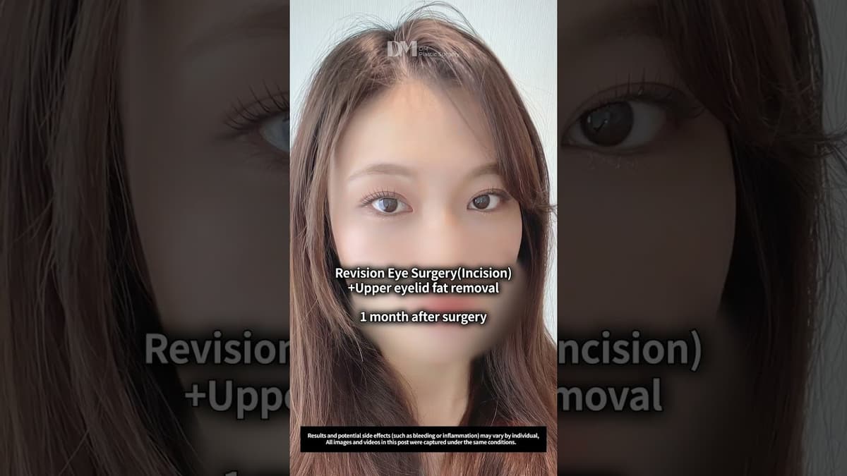 Natural eye glow-up #dmplasticsurgery #eyesurgery #beforeafter #kbeauty #travelkorea #seoul #trend